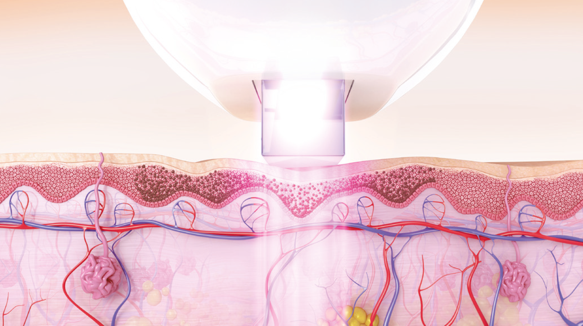Venus-Versa-1 Venus Versa Laserbehandlung bei Dr. Verena Beck