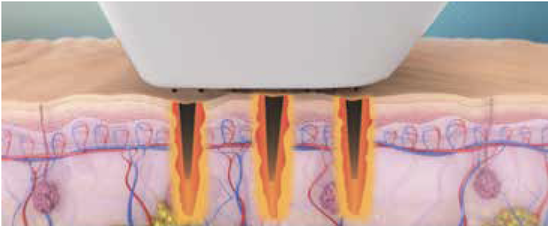 Bildschirmfoto 2021-05-26 um 11.33.54 Dr. Verena Beck Laserbehandlung