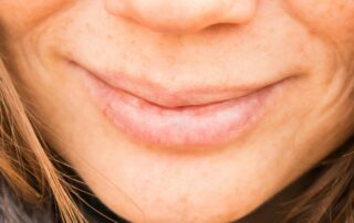 Fieberblasen behandeln