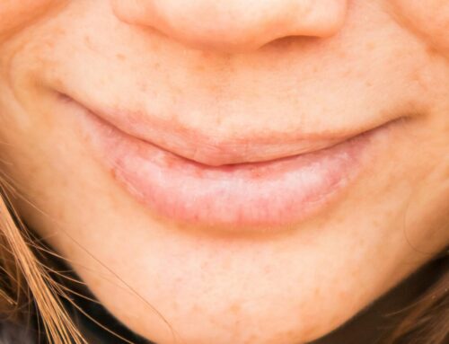 Was hilft bei Fieberblasen?