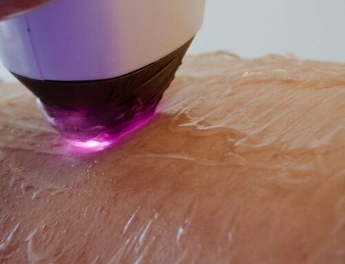 Warum der Winter ideal für Laser, Peeling und Co. ist