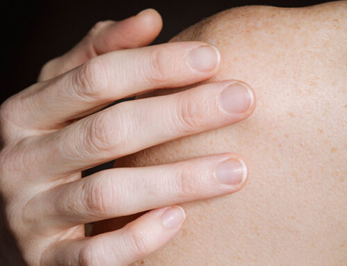 Hypomelanose: Im Alter weiße Flecken auf der Haut?
